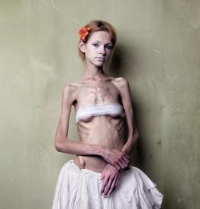 anorexia, bulimia, fashion, death, starvation, eating disorders, mental health
